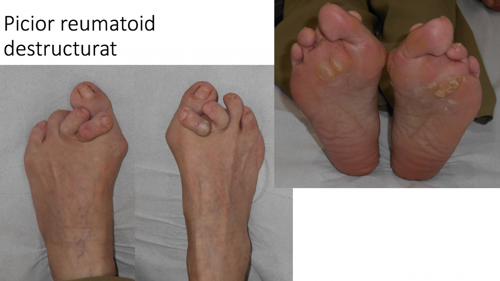artrita reumatoidă a piciorului articulația superioară a umărului
